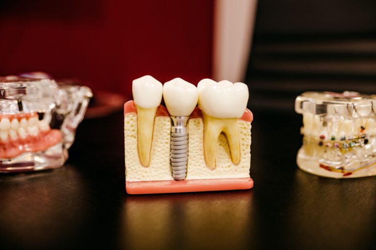 dental implants scaled