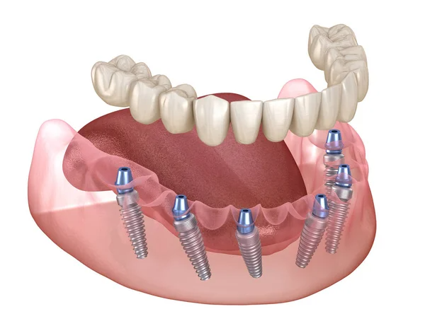 Fixed Dental Implant