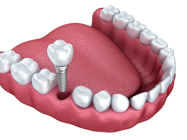 single tooth replacement