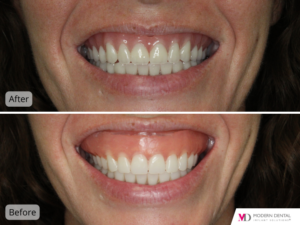 modern dental implant solutions before and after v