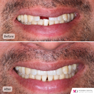 Dental Implant Before & After # Implant and final crown placed already