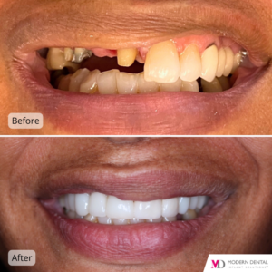 Dental Implant Before & After Upper arch rehabilitation with Crowns and Bridges