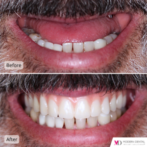 Dental Implant Before & After Upper fixed prosthesis on Implants (All on )